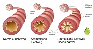 Wereld astmadag | Revant helpt mensen met astmaklachten